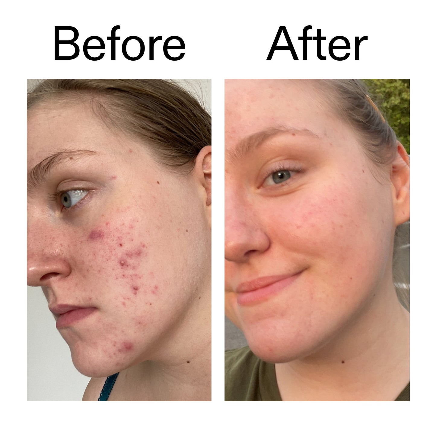 glycolic-acid-toner-i9 Glycolic_Acid_Toner_Before_After_2000x2000_49f0b9f7-e71b-4b2e-a8f8-2ea4b73247bb.jpg
