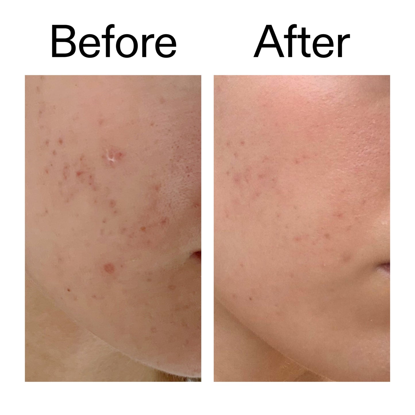 mandelic-acid-treatment-v0 Mandelic_Acid_Treatment_Before_After_2000x2000_4885ac6e-c5d7-4279-a72a-1417af7dce35.jpg