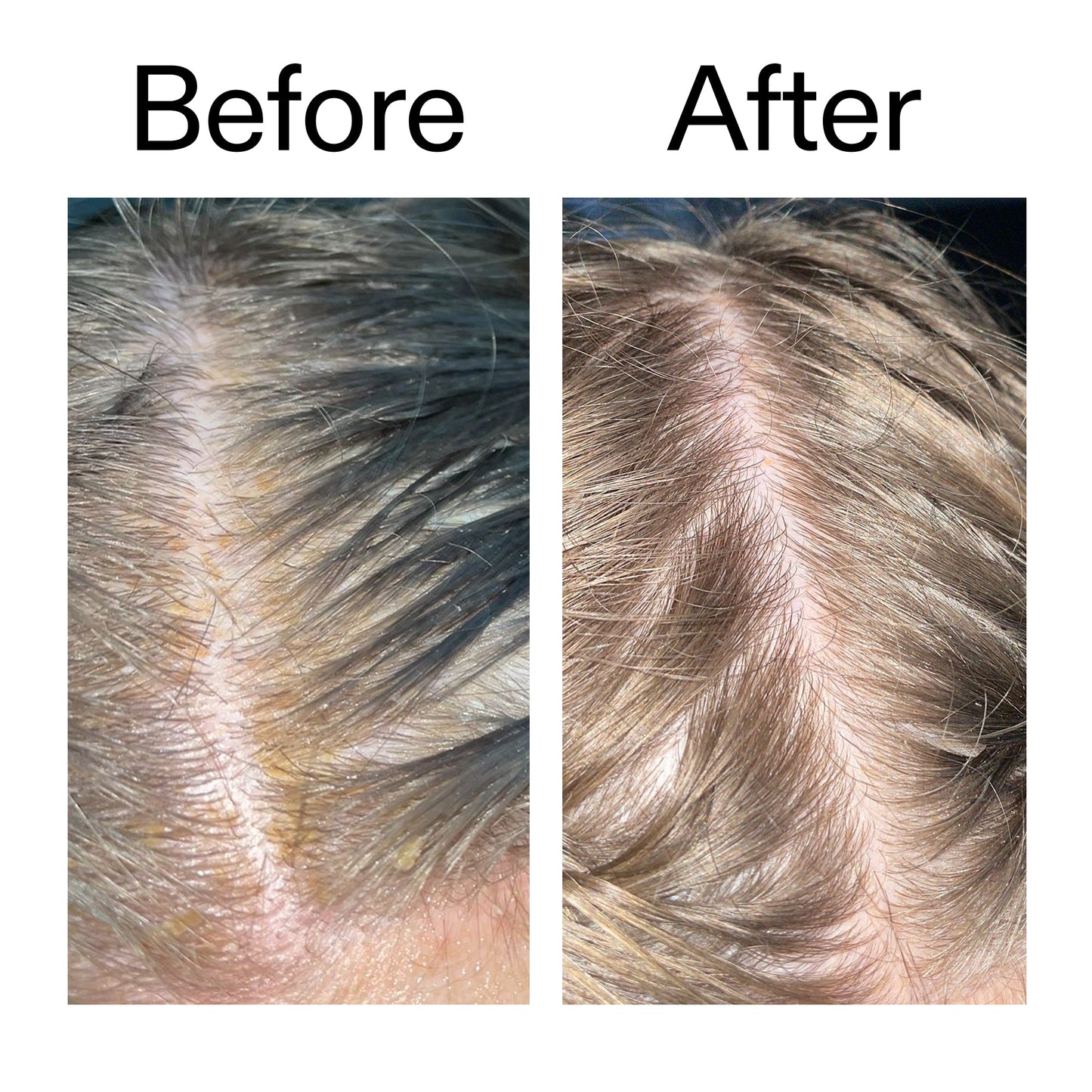 salicylic-acid-exfoliating-scalp-treatment-s7 Salicylic_Acid_Exfoliating_Scalp_Treatment_Before_After_2000x2000_e572a30f-057c-4a48-823b-1c09dc97f8d0.jpg