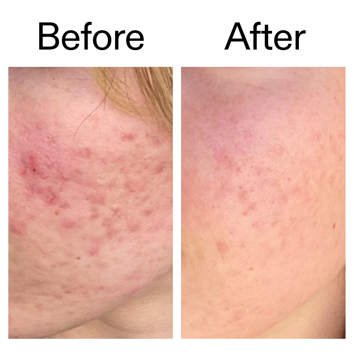 10-azelaic-acid-serum-for-redness-relief-a7 Azealic_Acid_Serum_B_A_Ppage_2000_x_2000.jpg