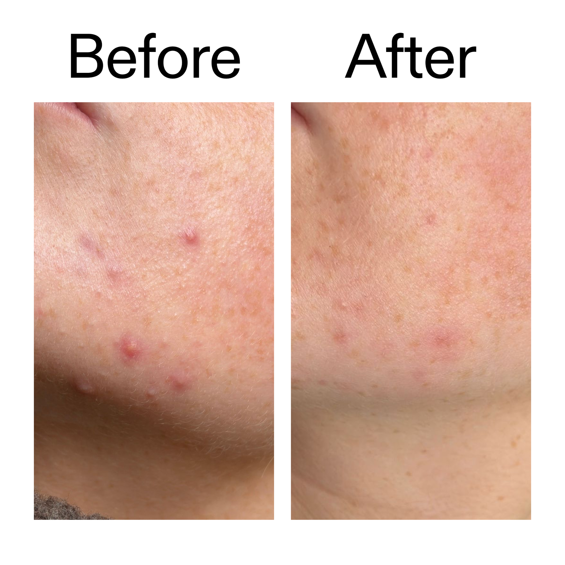 10-azelaic-acid-serum-for-redness-relief-a7 B_A_1_PPAGE.png