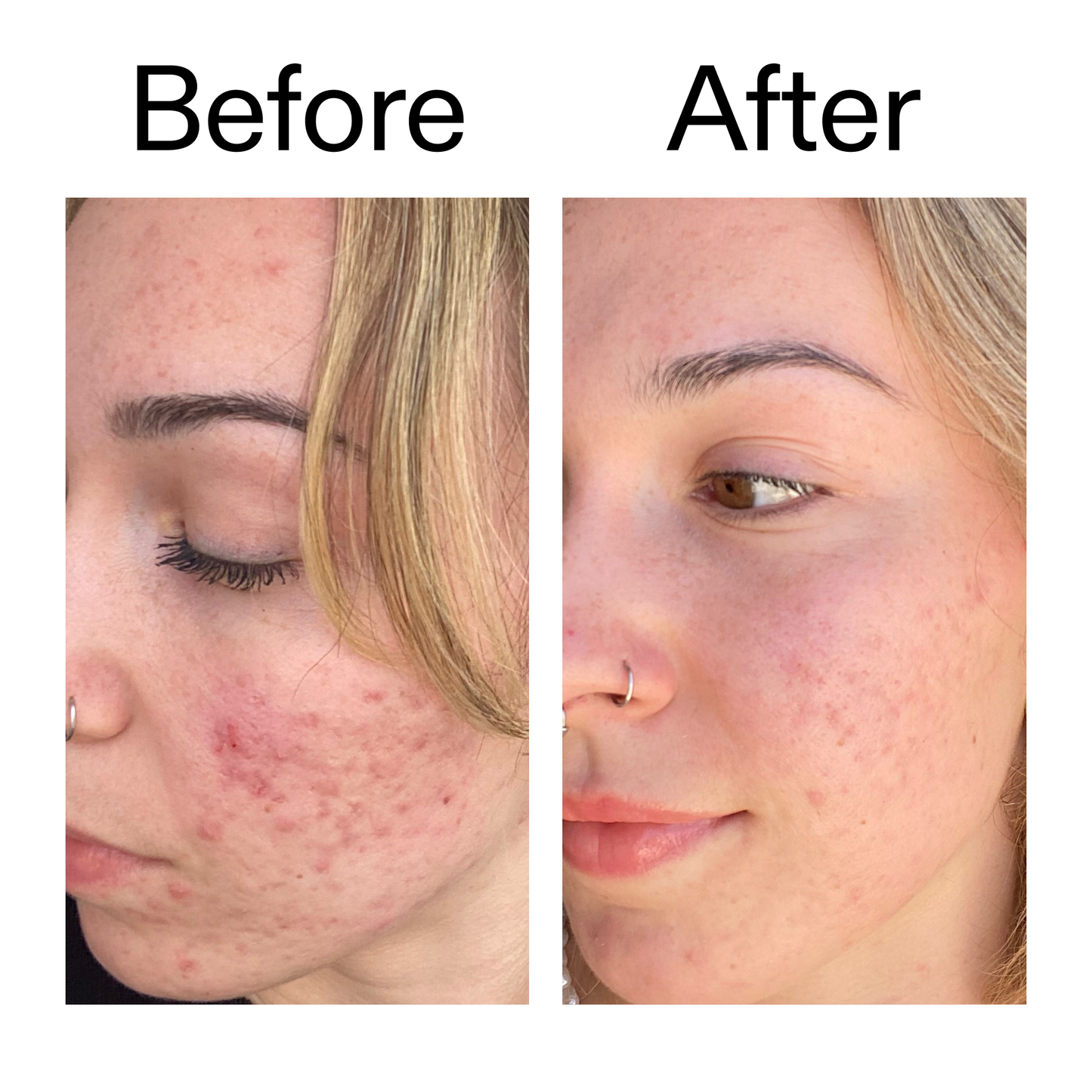 10-azelaic-acid-serum-for-redness-relief-a7 B_A_2_PPAGE.png