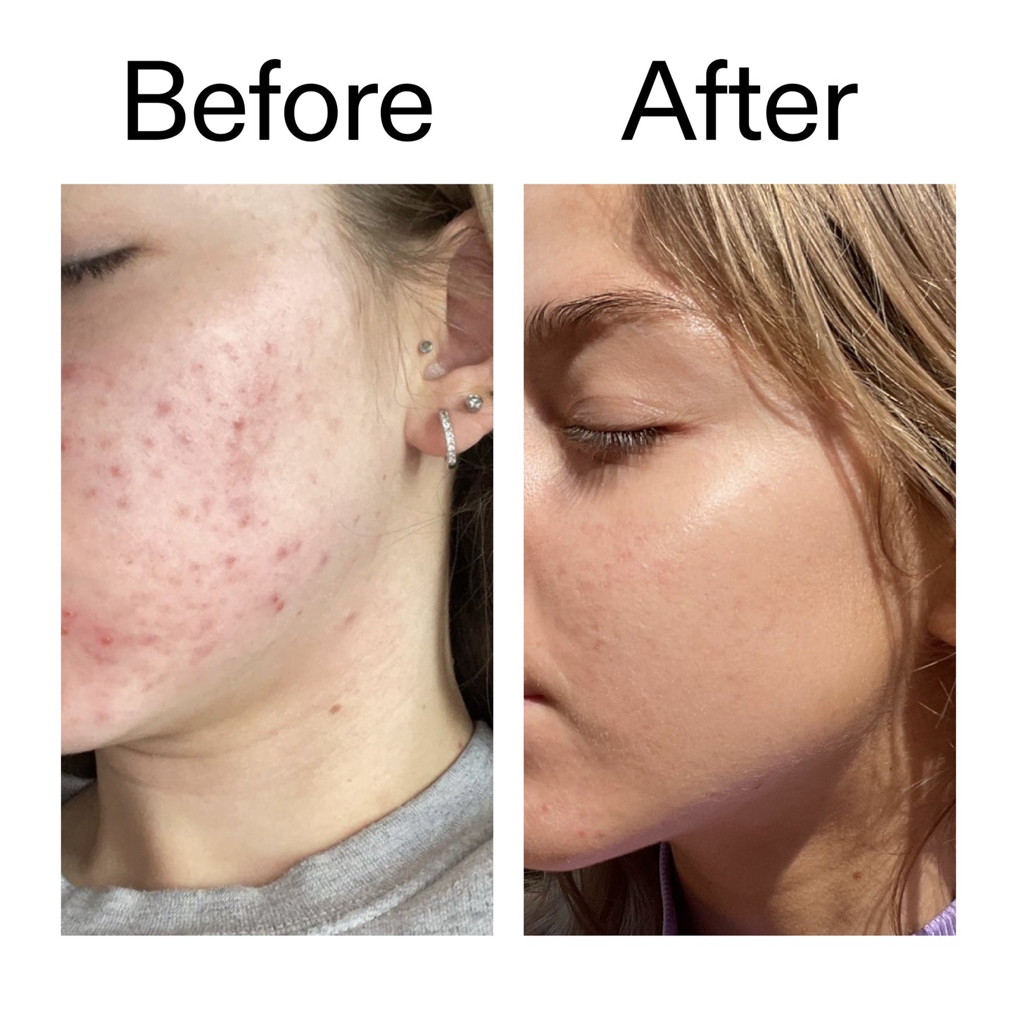 beta-hydroxy-acid-bha-serum-r4 Beta_Hydroxy_Acid_Serum_Before_After_2000x2000_96fda3e5-938d-49ef-bcf2-a0fa6ece4e2c.jpg