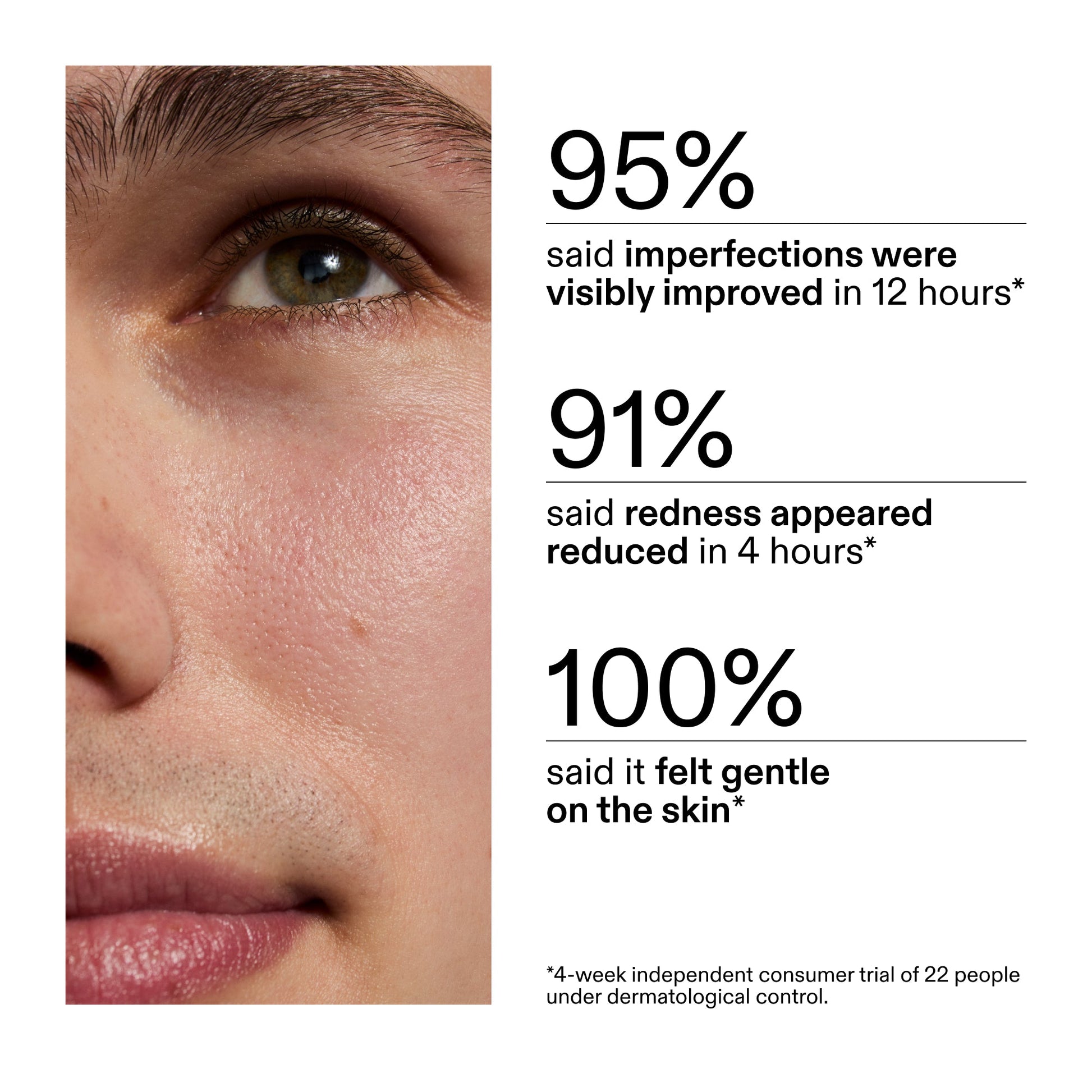 succinic-acid-acne-treatment-r6 CA_Succinic_Acid_Treatment_key_Claims_2000x2000_db91b0f1-7f29-4bfe-bb16-63a47f500960.jpg