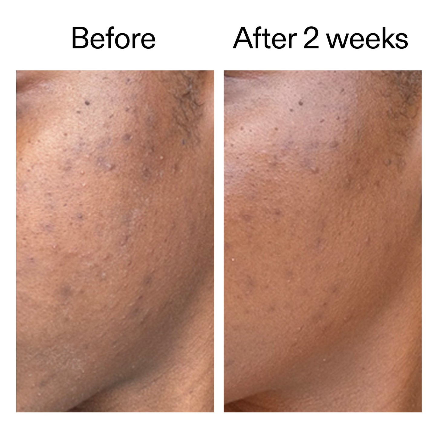 360-acne-clearing-serum-h5 DIOICB_A2000x2000.jpg