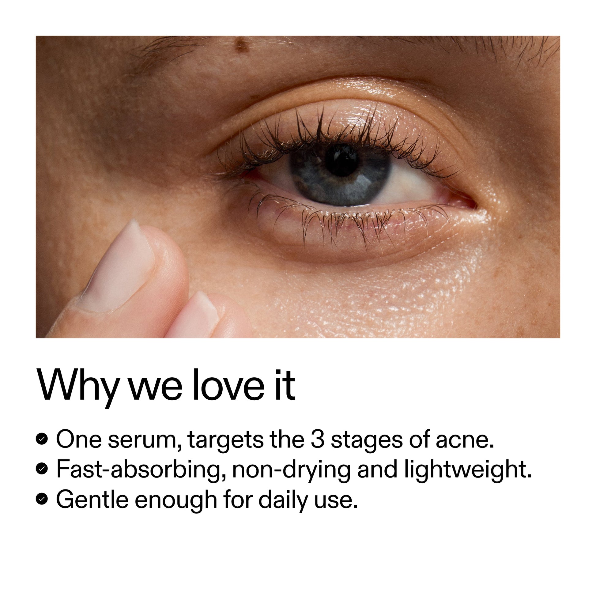 360-acne-clearing-serum-h5 Dioic_Whyweloveit_2000x2000_175aafd3-0cbe-403a-b317-a8362881bfe2.jpg