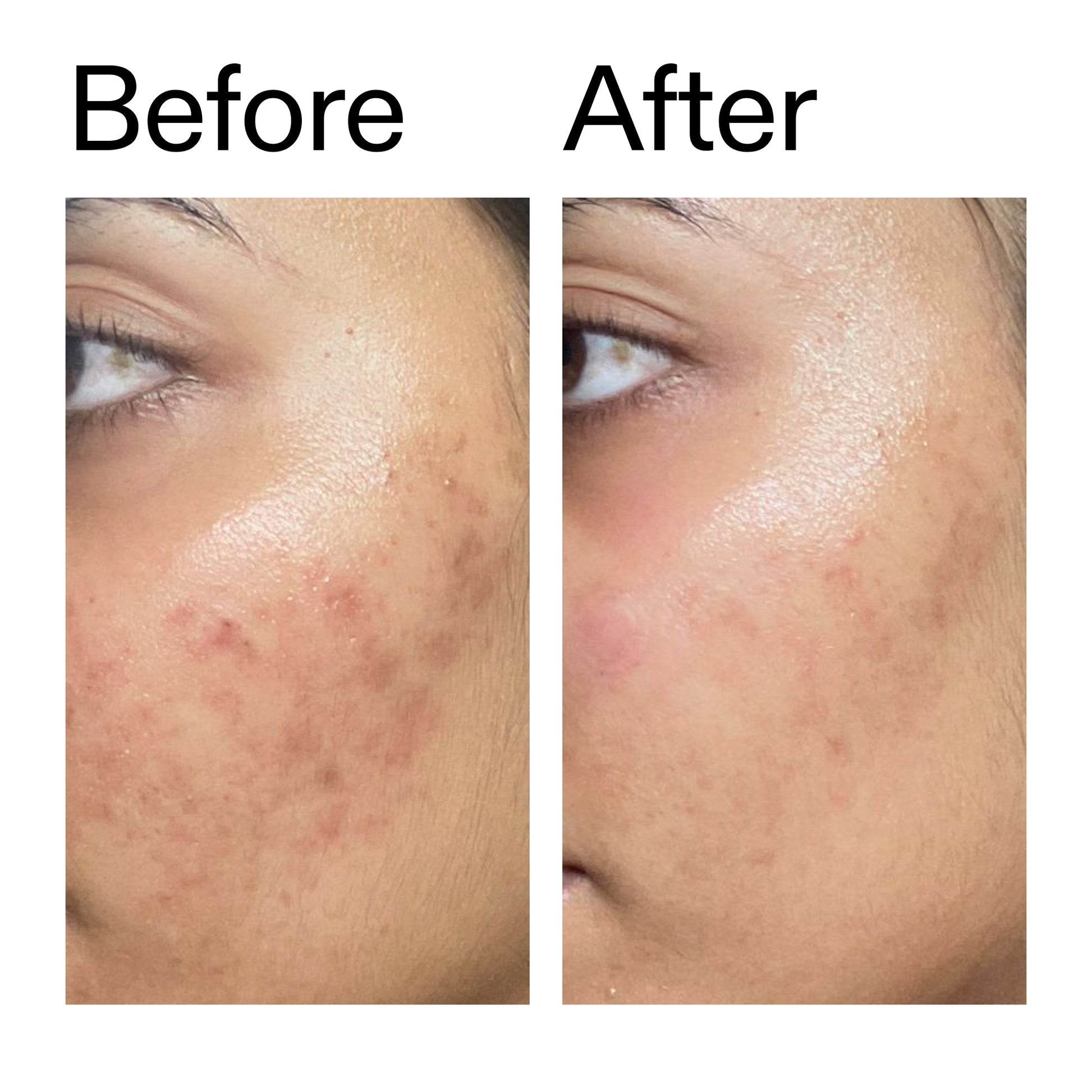 ectoin-hydro-barrier-serum-o5 Ectoin_Hydro-barrier_Serum__Before_After_2000x2000_34261920-d004-48d0-9c7b-8e1c15971bfd.jpg