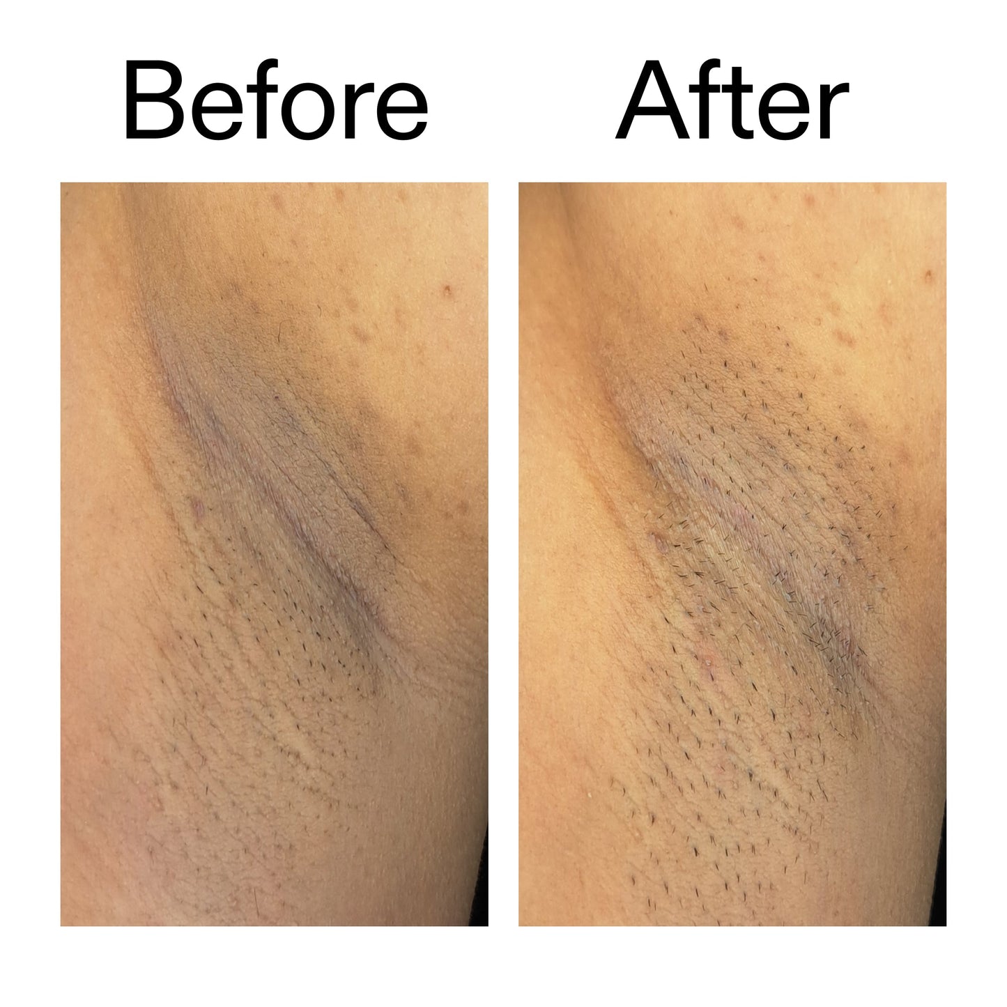 glycolic-acid-exfoliating-body-stick-z2 Glycolic_Acid_Exfoliating_Body_Stick_Before_After_V3_2000x2000_ea919cd9-1439-4a46-82a0-76200eb5bb42.jpg