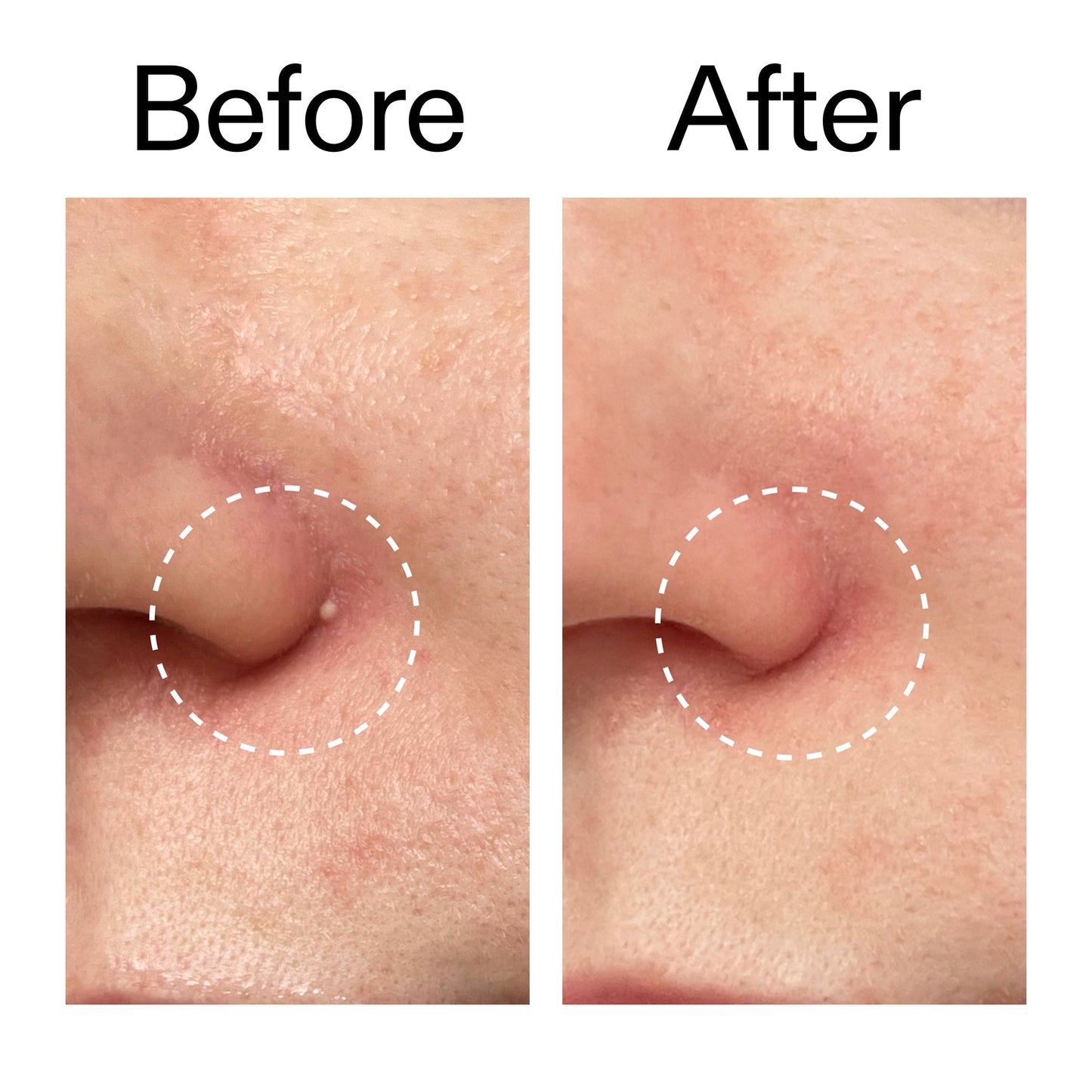 hydrocolloid-invisible-pimple-patches-pack-of-22-b5 Hydrocolloid_Invisible_Pimple_Patches_Before_After_2000x2000_b02aa37b-c78a-4682-91de-9135af5bb7df.jpg