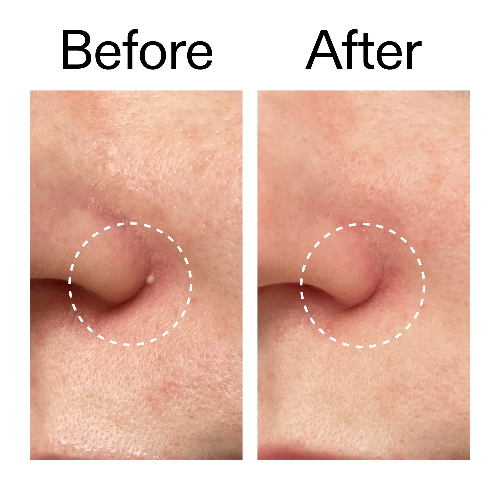 hydrocolloid-invisible-pimple-patches-pack-of-44-h2 Hydrocolloid_Invisible_Pimple_Patches_Before_After_2000x2000_b02aa37b-c78a-4682-91de-9135af5bb7df.jpg