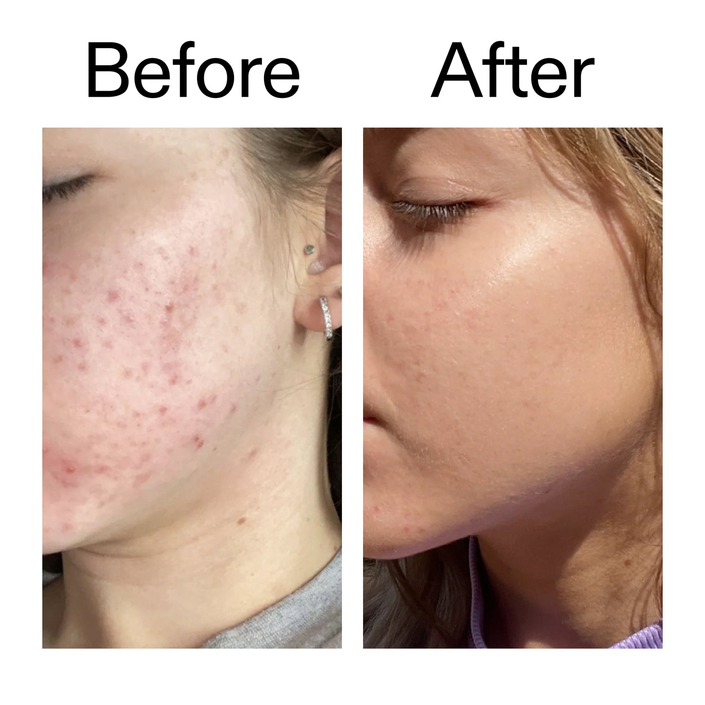 10-niacinamide-serum-c9 Niacinamide_Serum_Before_After_2000x2000_bde32455-9e7d-448e-b053-bef41504f0a9.jpg
