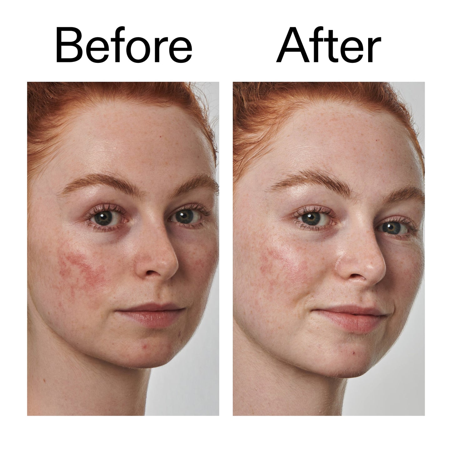 10-azelaic-acid-serum-for-redness-relief-a7 Redness_Relief_Serum_Before_After_2000x2000_3334dc9a-cce9-4e00-8aec-7ad89ca051f2.jpg