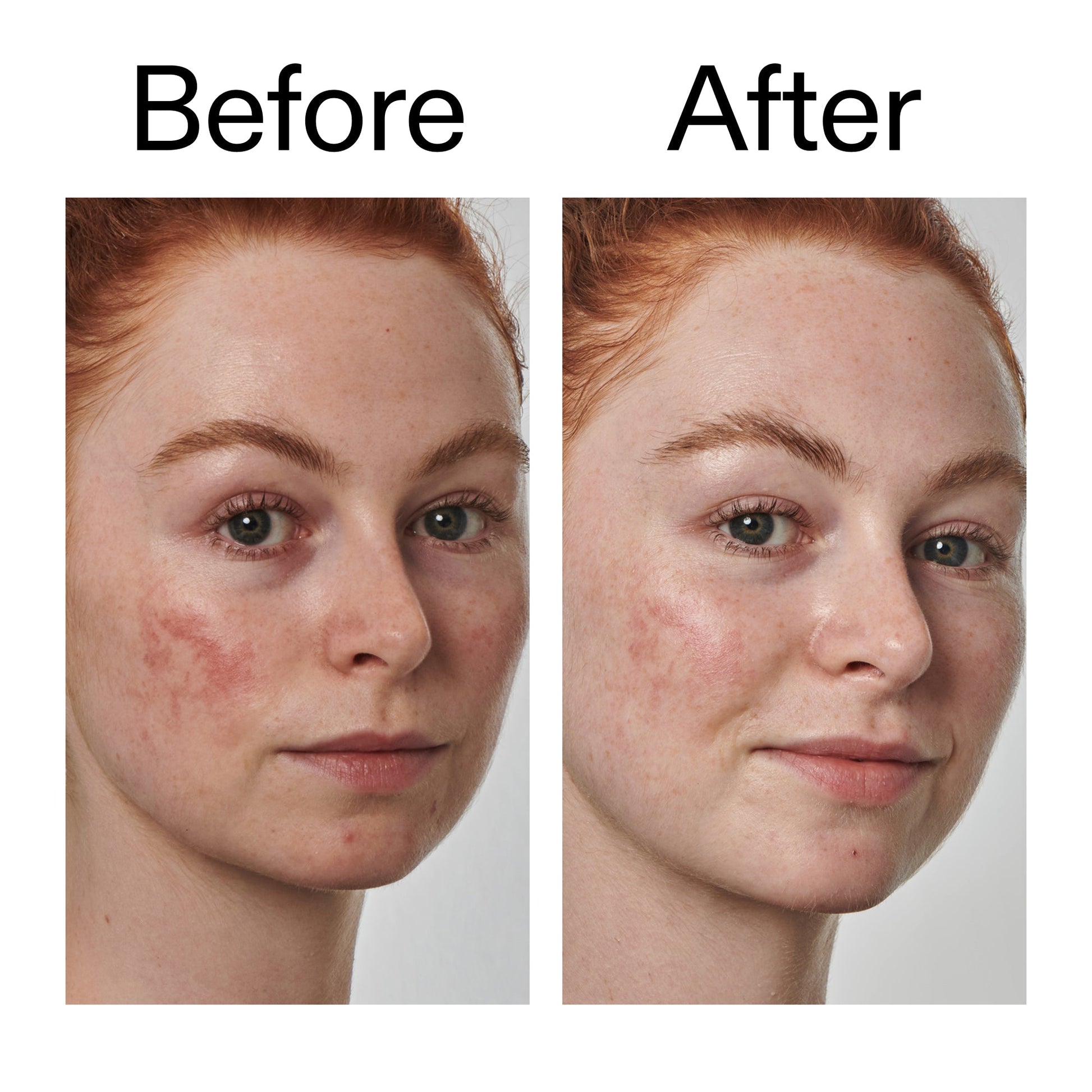 10-azelaic-acid-serum-for-redness-relief-a7 Redness_Relief_Serum_Before_After_2000x2000_3334dc9a-cce9-4e00-8aec-7ad89ca051f2.jpg