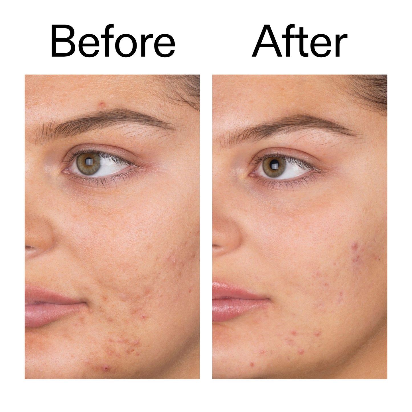 salicylic-acid-cleanser-150ml-u8 Salicylic_Acid_Cleanser_-_150ml_Before_After_2000x2000_e7230494-853f-4b07-82b1-27669104c995.jpg