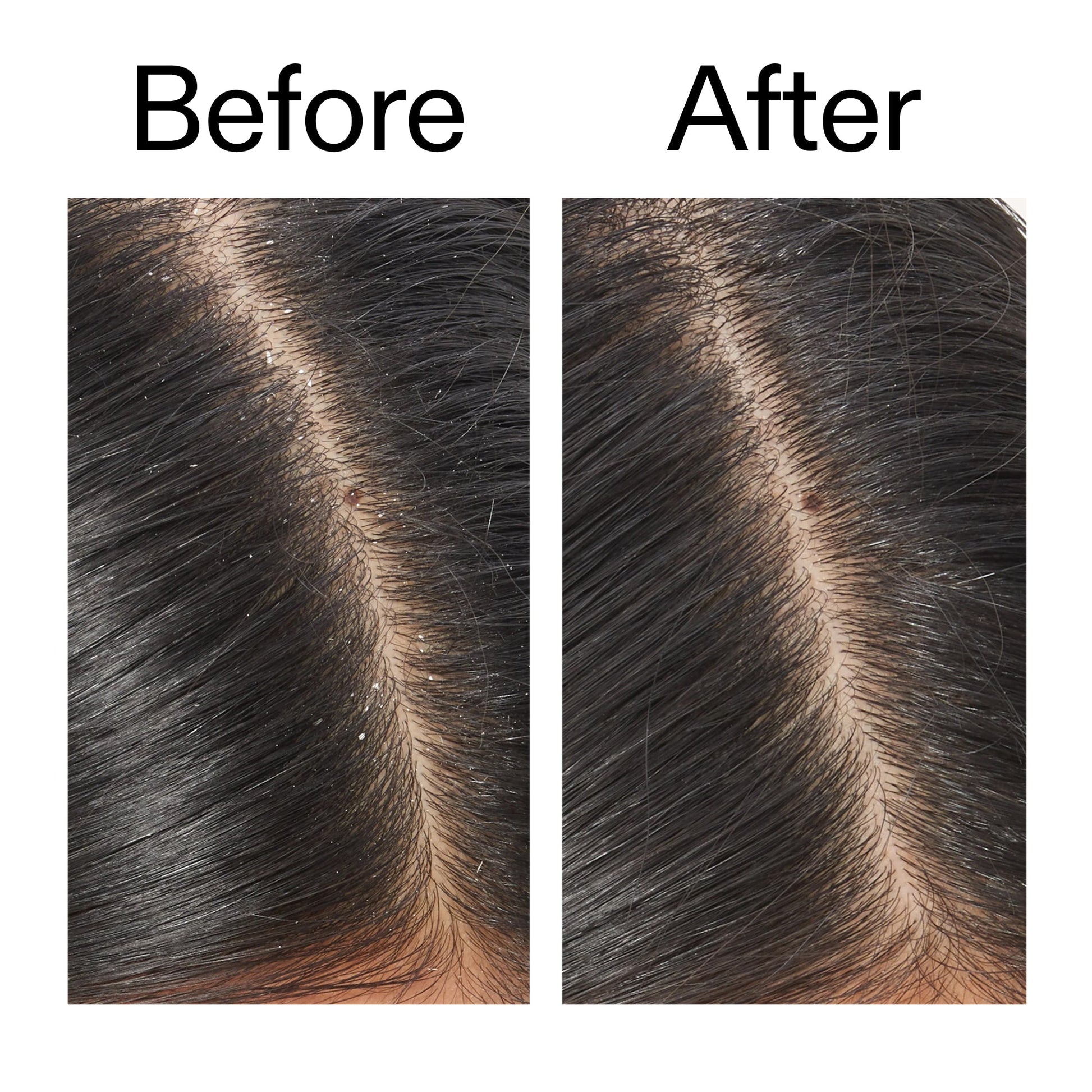 salicylic-acid-exfoliating-scalp-treatment-s7 Salicylic_Acid_Exfoliating_Scalp_Treatment_Before_After_V2_2000x2000_02bd61ad-42bf-490b-b3e3-7e04b2e8a673.jpg