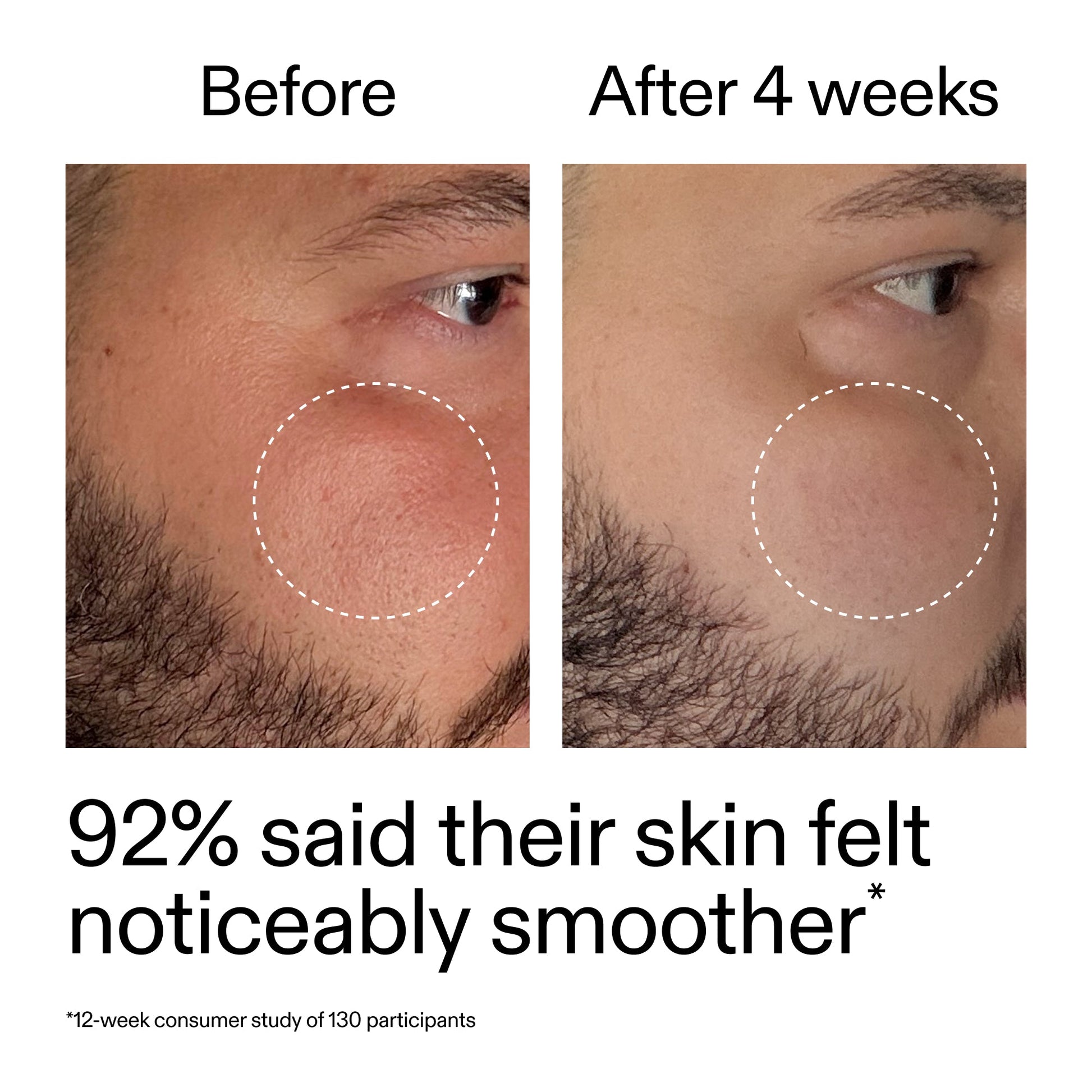 starter-retinol-serum-duo-h3 StarterRetinol_BeforeAfter_Claim3_2000x2000_458243a8-bbb0-4e5d-a274-29c7766d339b.jpg