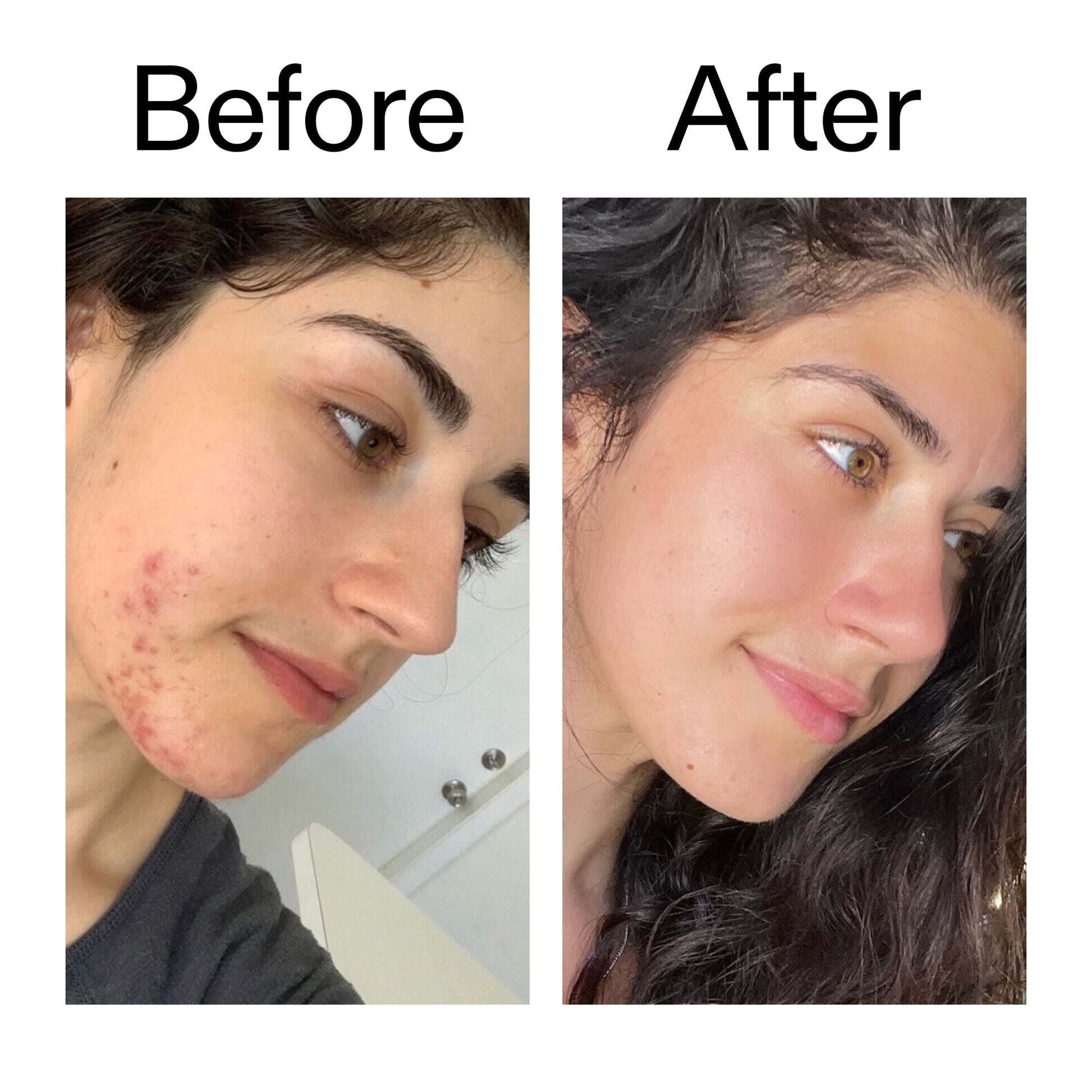 succinic-acid-acne-treatment-r6 Succinic_Acid_Treatment_Before_After_2000x2000_6a5f0054-2f58-4433-9314-0dc72c9bdd3b.jpg