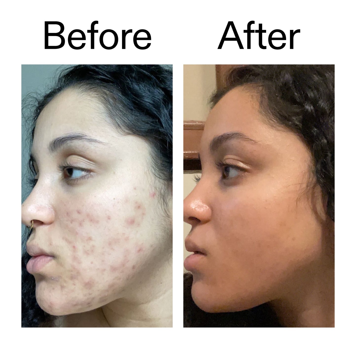 tranexamic-acid-serum-c7 Tranexamic_Acid_Serum_Before_After_2000x2000_98ebc8be-77b0-4843-8a22-90790ebe918b.jpg